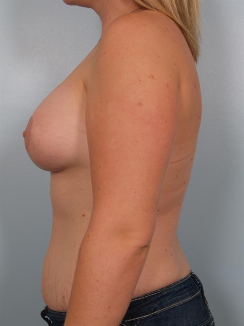 Breast Augmentation After Photo | Phoenix and Scottsdale, AZ | Scottsdale Center for Plastic Surgery