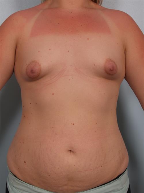 Breast Augmentation Before Photo | Phoenix and Scottsdale, AZ | Scottsdale Center for Plastic Surgery