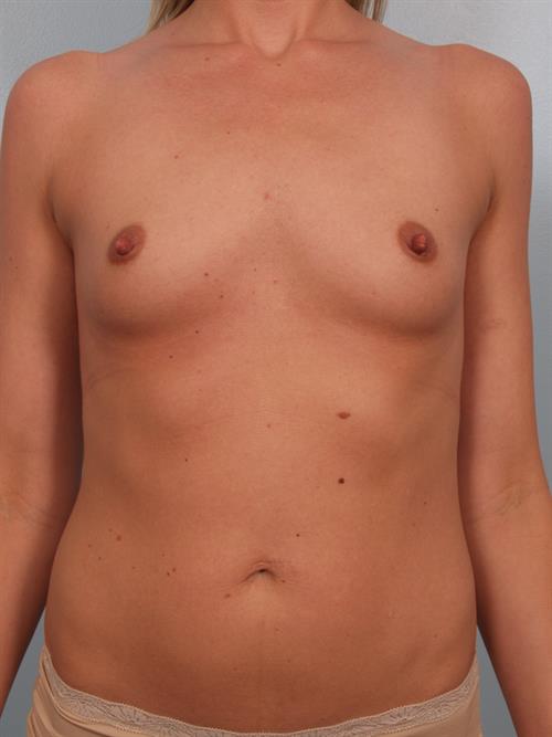 Breast Augmentation Before Photo | Phoenix and Scottsdale, AZ | Scottsdale Center for Plastic Surgery