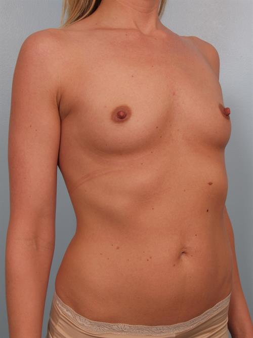 Breast Augmentation Before Photo | Phoenix and Scottsdale, AZ | Scottsdale Center for Plastic Surgery