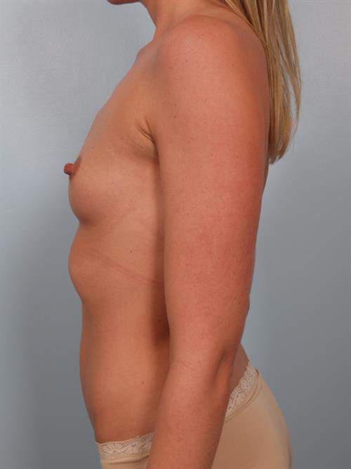 Breast Augmentation Before Photo | Phoenix and Scottsdale, AZ | Scottsdale Center for Plastic Surgery