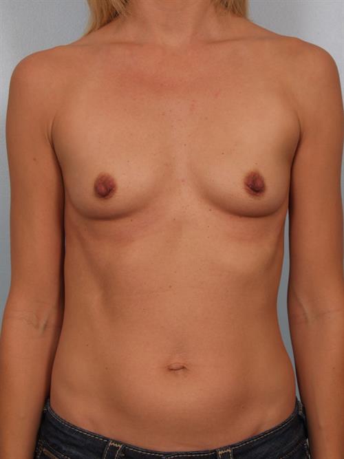 Breast Augmentation Before Photo | Phoenix and Scottsdale, AZ | Scottsdale Center for Plastic Surgery