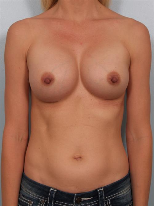 Breast Augmentation After Photo | Phoenix and Scottsdale, AZ | Scottsdale Center for Plastic Surgery