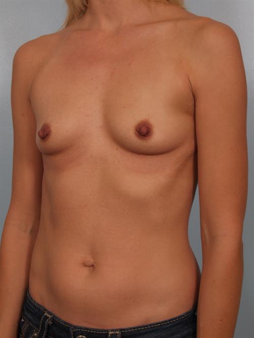 Breast Augmentation Before Photo | Phoenix and Scottsdale, AZ | Scottsdale Center for Plastic Surgery