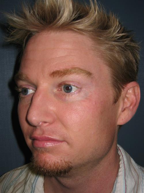 Botox Before Photo | Phoenix and Scottsdale, AZ | Scottsdale Center for Plastic Surgery