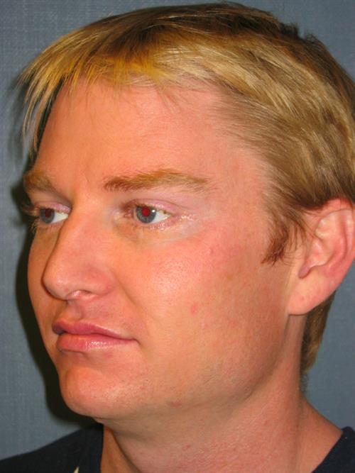 Botox After Photo | Phoenix and Scottsdale, AZ | Scottsdale Center for Plastic Surgery