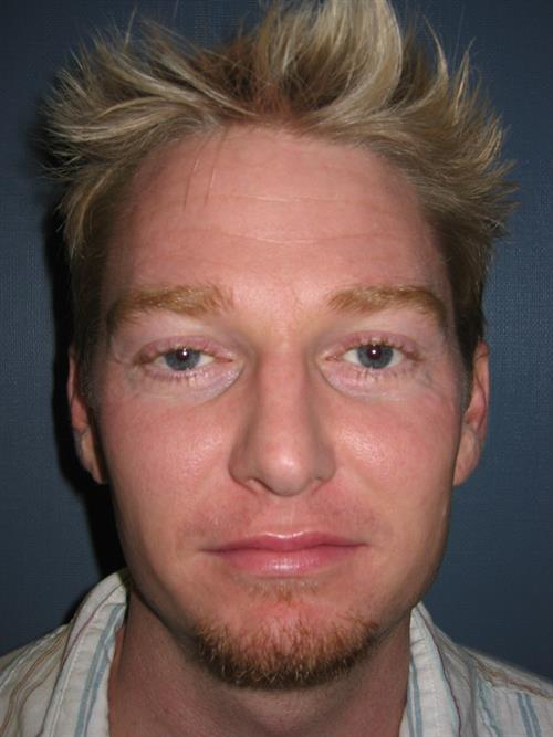 Botox Before Photo | Phoenix and Scottsdale, AZ | Scottsdale Center for Plastic Surgery