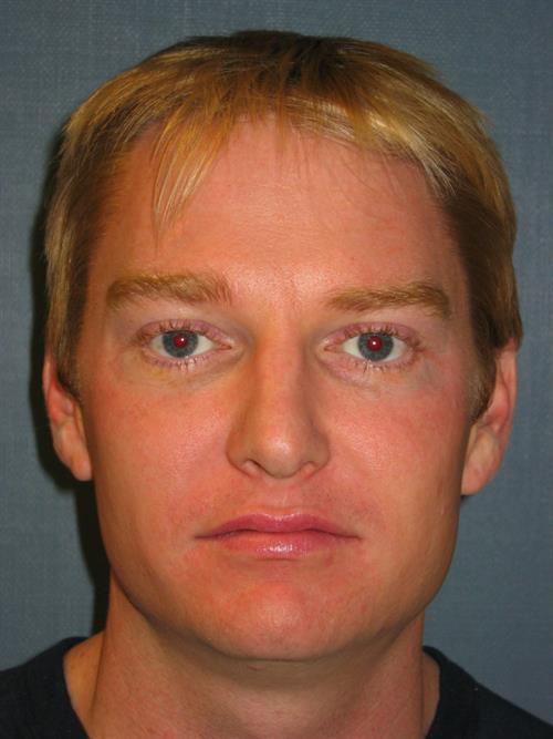 Botox After Photo | Phoenix and Scottsdale, AZ | Scottsdale Center for Plastic Surgery