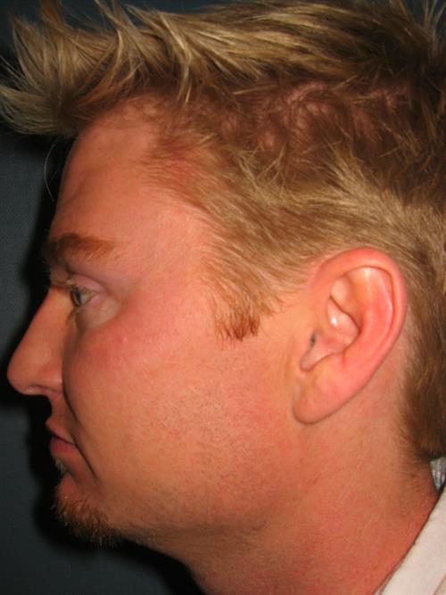 Botox Before Photo | Phoenix and Scottsdale, AZ | Scottsdale Center for Plastic Surgery