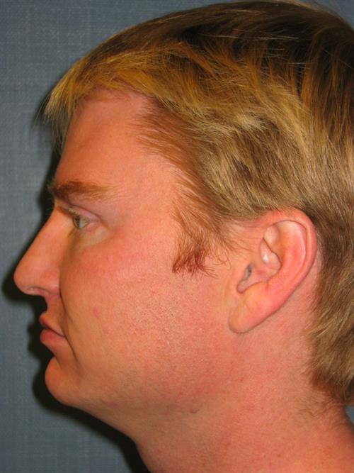 Botox After Photo | Phoenix and Scottsdale, AZ | Scottsdale Center for Plastic Surgery