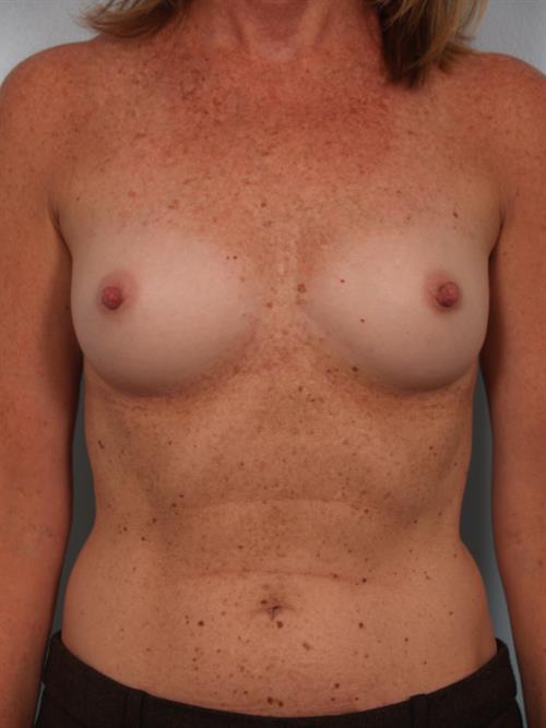 Breast Augmentation Before Photo | Phoenix and Scottsdale, AZ | Scottsdale Center for Plastic Surgery