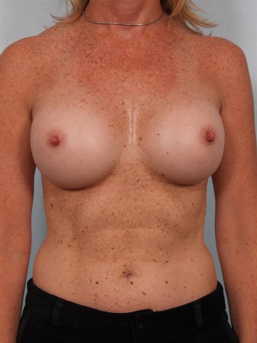 Breast Augmentation After Photo | Phoenix and Scottsdale, AZ | Scottsdale Center for Plastic Surgery