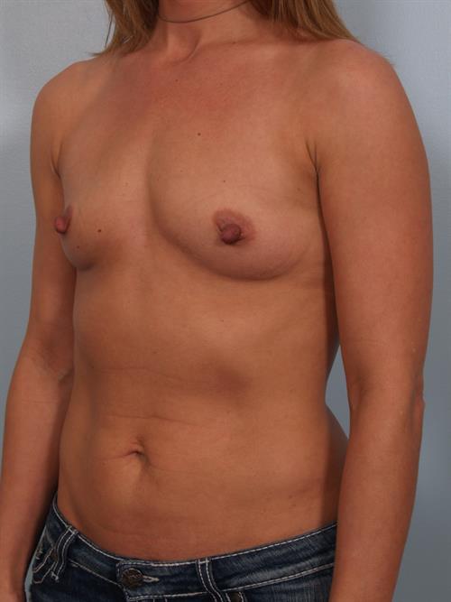 Breast Augmentation Before Photo | Phoenix and Scottsdale, AZ | Scottsdale Center for Plastic Surgery