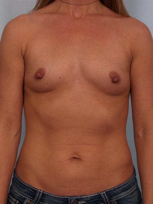 Breast Augmentation Before Photo | Phoenix and Scottsdale, AZ | Scottsdale Center for Plastic Surgery