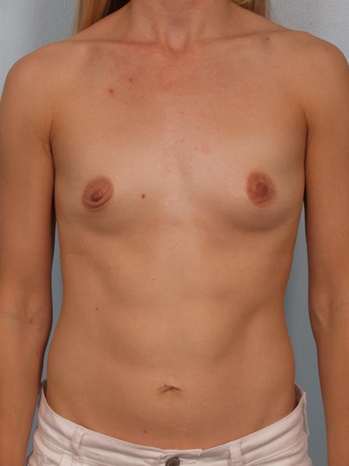 Breast Augmentation Before Photo | Phoenix and Scottsdale, AZ | Scottsdale Center for Plastic Surgery