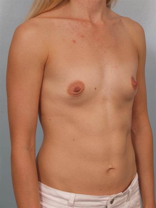 Breast Augmentation Before Photo | Phoenix and Scottsdale, AZ | Scottsdale Center for Plastic Surgery