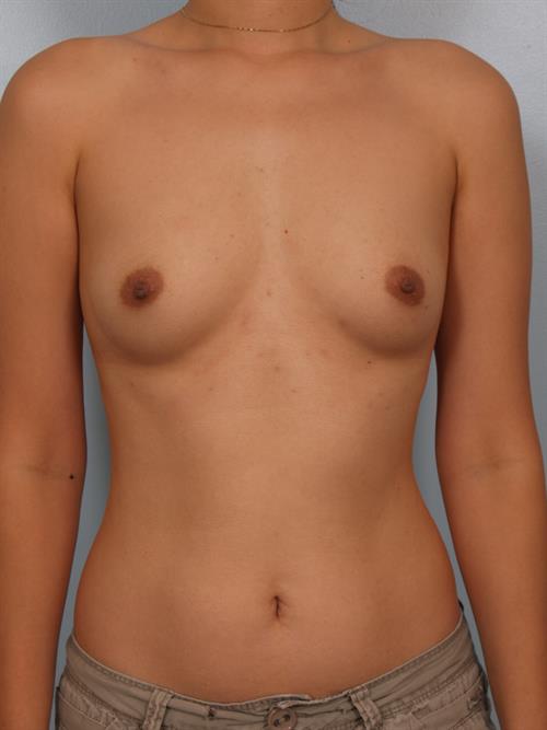 Breast Augmentation Before Photo | Phoenix and Scottsdale, AZ | Scottsdale Center for Plastic Surgery