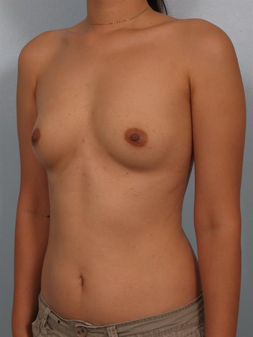 Breast Augmentation Before Photo | Phoenix and Scottsdale, AZ | Scottsdale Center for Plastic Surgery