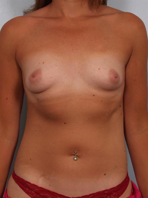 Breast Augmentation Before Photo | Phoenix and Scottsdale, AZ | Scottsdale Center for Plastic Surgery