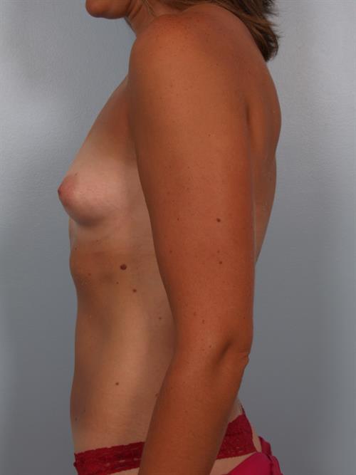 Breast Augmentation Before Photo | Phoenix and Scottsdale, AZ | Scottsdale Center for Plastic Surgery