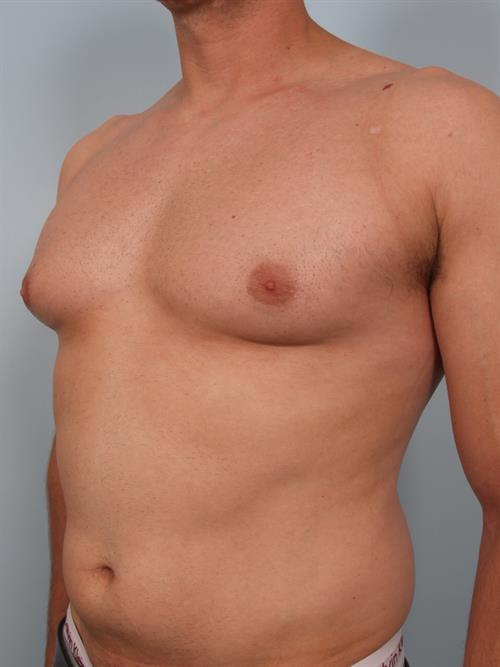 Male Breast/Areola Reduction Before Photo | Phoenix and Scottsdale, AZ | Scottsdale Center for Plastic Surgery