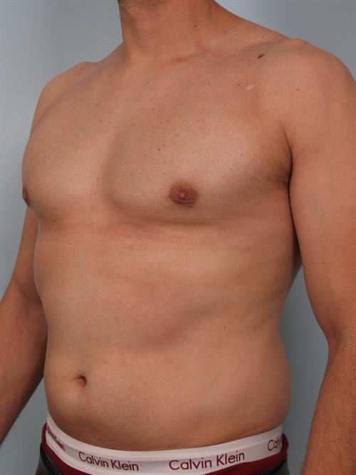 Male Breast/Areola Reduction After Photo | Phoenix and Scottsdale, AZ | Scottsdale Center for Plastic Surgery