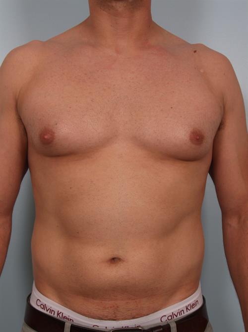 Male Breast/Areola Reduction Before Photo | Phoenix and Scottsdale, AZ | Scottsdale Center for Plastic Surgery