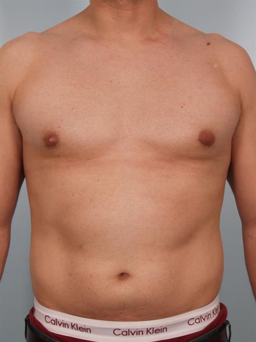 Male Breast/Areola Reduction After Photo | Phoenix and Scottsdale, AZ | Scottsdale Center for Plastic Surgery