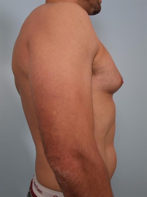Male Breast/Areola Reduction Before Photo | Phoenix and Scottsdale, AZ | Scottsdale Center for Plastic Surgery