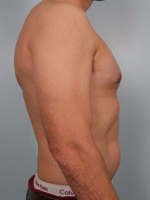Male Breast/Areola Reduction After Photo | Phoenix and Scottsdale, AZ | Scottsdale Center for Plastic Surgery