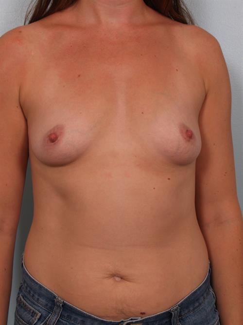 Breast Augmentation Before Photo | Phoenix and Scottsdale, AZ | Scottsdale Center for Plastic Surgery