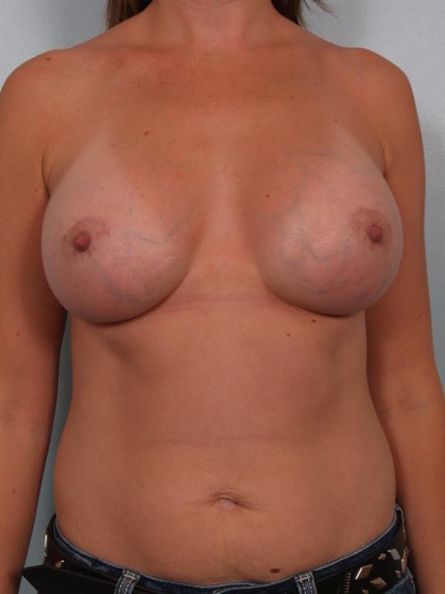 Breast Augmentation After Photo | Phoenix and Scottsdale, AZ | Scottsdale Center for Plastic Surgery