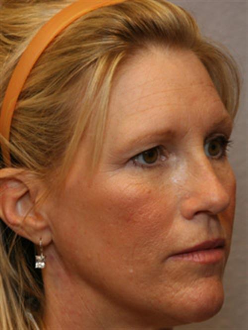 Restylane Before Photo | Phoenix and Scottsdale, AZ | Scottsdale Center for Plastic Surgery