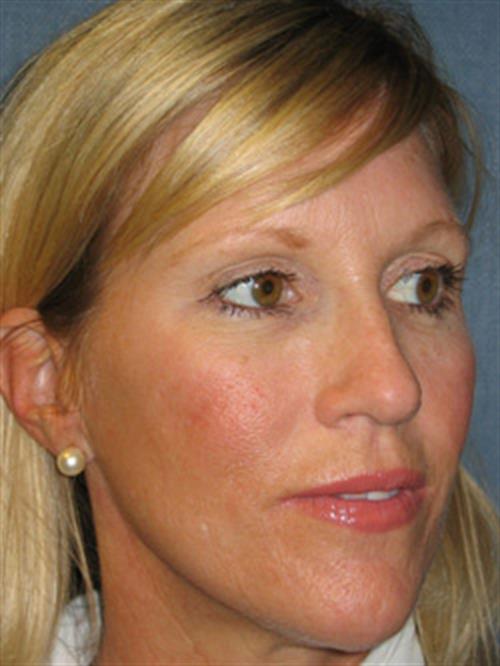 Restylane After Photo | Phoenix and Scottsdale, AZ | Scottsdale Center for Plastic Surgery