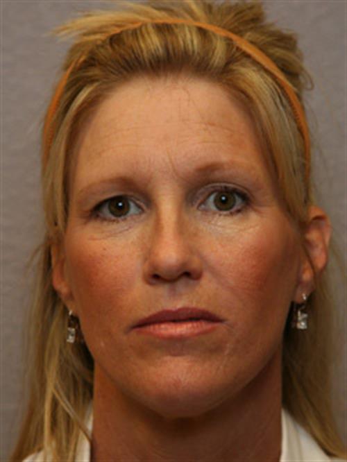 Botox Before Photo | Phoenix and Scottsdale, AZ | Scottsdale Center for Plastic Surgery