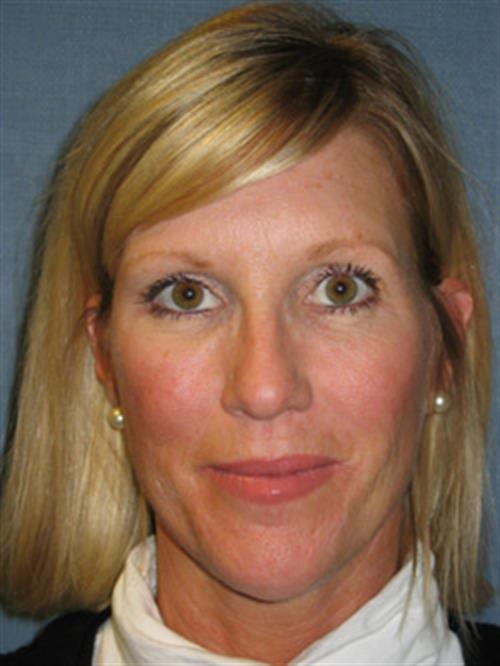 Botox After Photo | Phoenix and Scottsdale, AZ | Scottsdale Center for Plastic Surgery