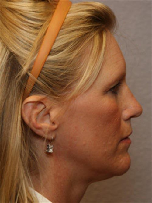 Restylane Before Photo | Phoenix and Scottsdale, AZ | Scottsdale Center for Plastic Surgery