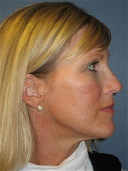 Restylane After Photo | Phoenix and Scottsdale, AZ | Scottsdale Center for Plastic Surgery