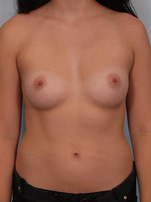 Breast Augmentation Before Photo | Phoenix and Scottsdale, AZ | Scottsdale Center for Plastic Surgery