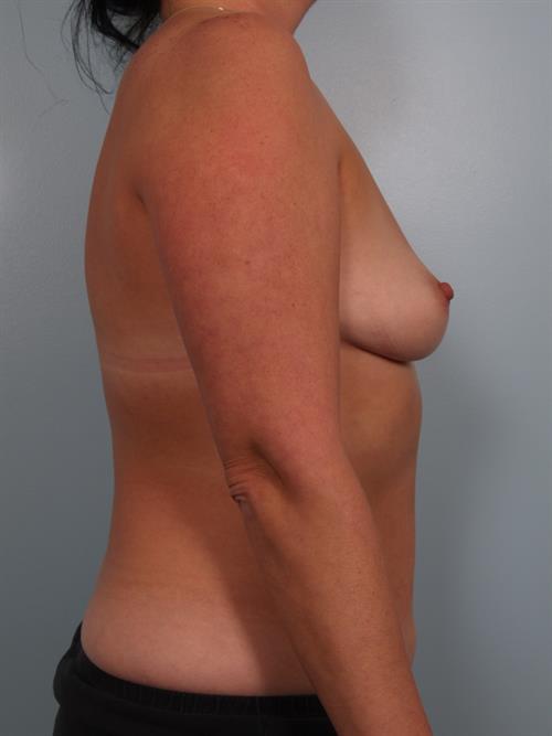 Breast Augmentation Before Photo | Phoenix and Scottsdale, AZ | Scottsdale Center for Plastic Surgery