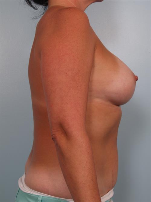 Breast Augmentation After Photo | Phoenix and Scottsdale, AZ | Scottsdale Center for Plastic Surgery