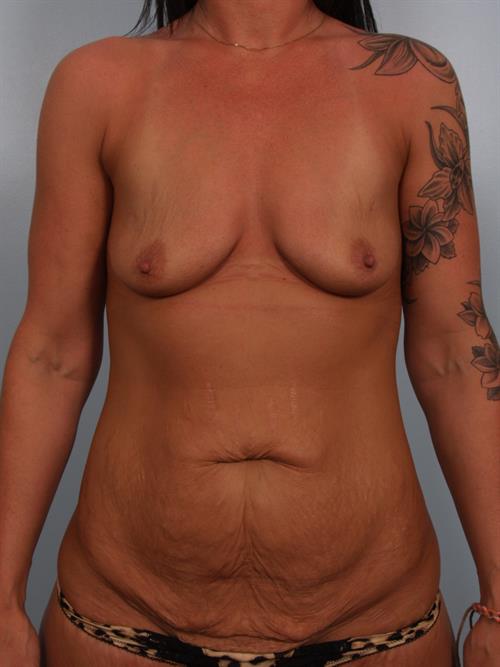 Tummy Tuck Before Photo | Phoenix and Scottsdale, AZ | Scottsdale Center for Plastic Surgery