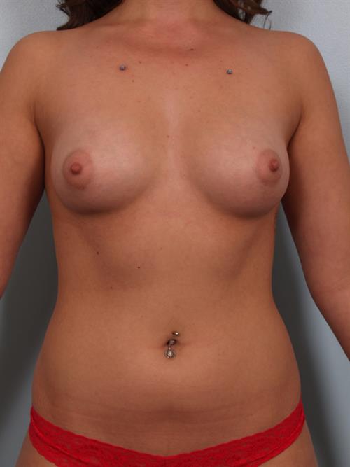 Breast Augmentation Before Photo | Phoenix and Scottsdale, AZ | Scottsdale Center for Plastic Surgery
