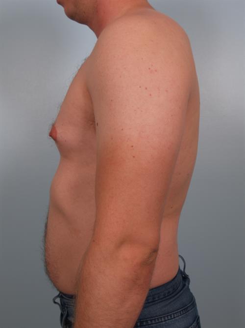 Male Breast/Areola Reduction Before Photo | Phoenix and Scottsdale, AZ | Scottsdale Center for Plastic Surgery
