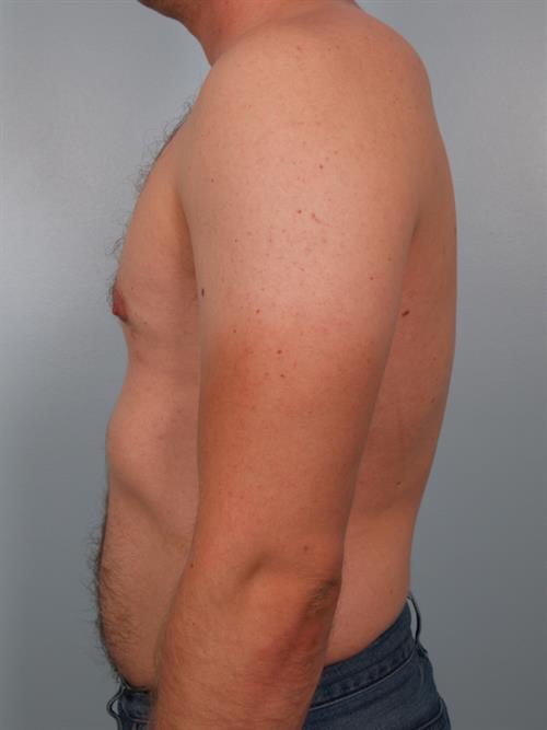 Male Breast/Areola Reduction After Photo | Phoenix and Scottsdale, AZ | Scottsdale Center for Plastic Surgery