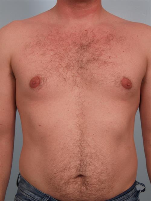 Male Breast/Areola Reduction Before Photo | Phoenix and Scottsdale, AZ | Scottsdale Center for Plastic Surgery