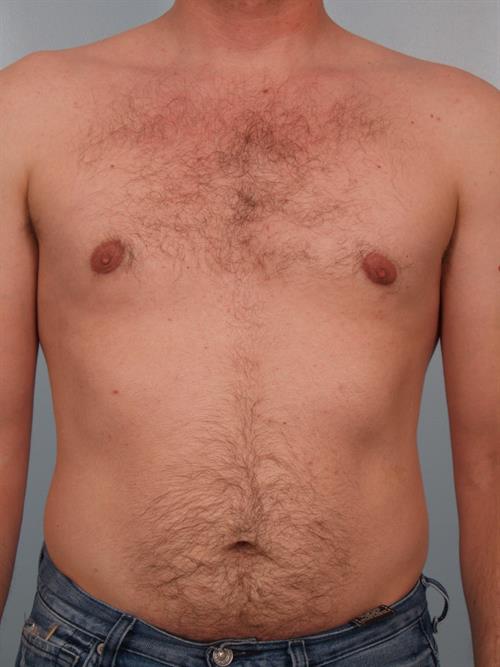 Male Breast/Areola Reduction After Photo | Phoenix and Scottsdale, AZ | Scottsdale Center for Plastic Surgery