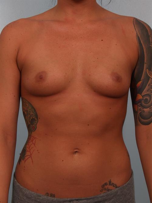 Breast Augmentation Before Photo | Phoenix and Scottsdale, AZ | Scottsdale Center for Plastic Surgery
