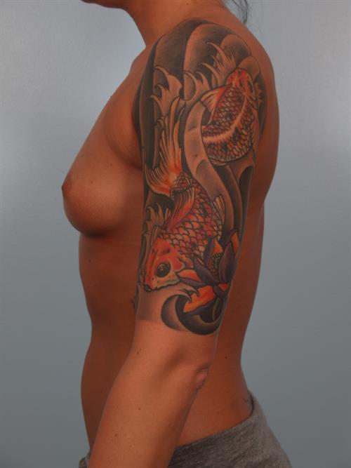 Breast Augmentation Before Photo | Phoenix and Scottsdale, AZ | Scottsdale Center for Plastic Surgery