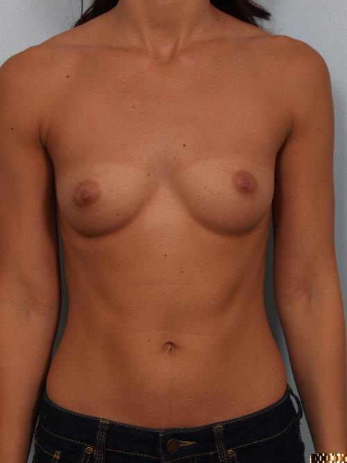 Breast Augmentation Before Photo | Phoenix and Scottsdale, AZ | Scottsdale Center for Plastic Surgery